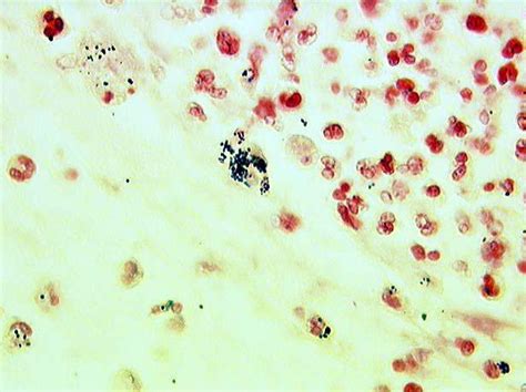 predominance of coccobacilli consistent with shift in flora|PREDOMINANCE OF COCCOBACILLI CONSISTENT .